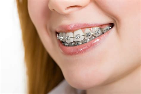 brackets metalicos pros y cons